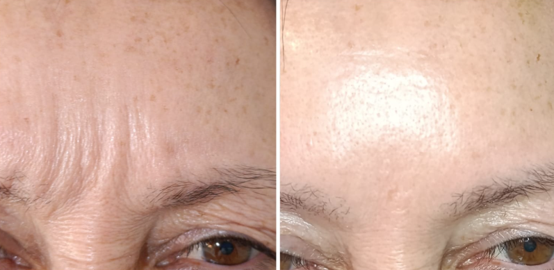 Antes y después - Tratamiento de arrugas del entrecejo