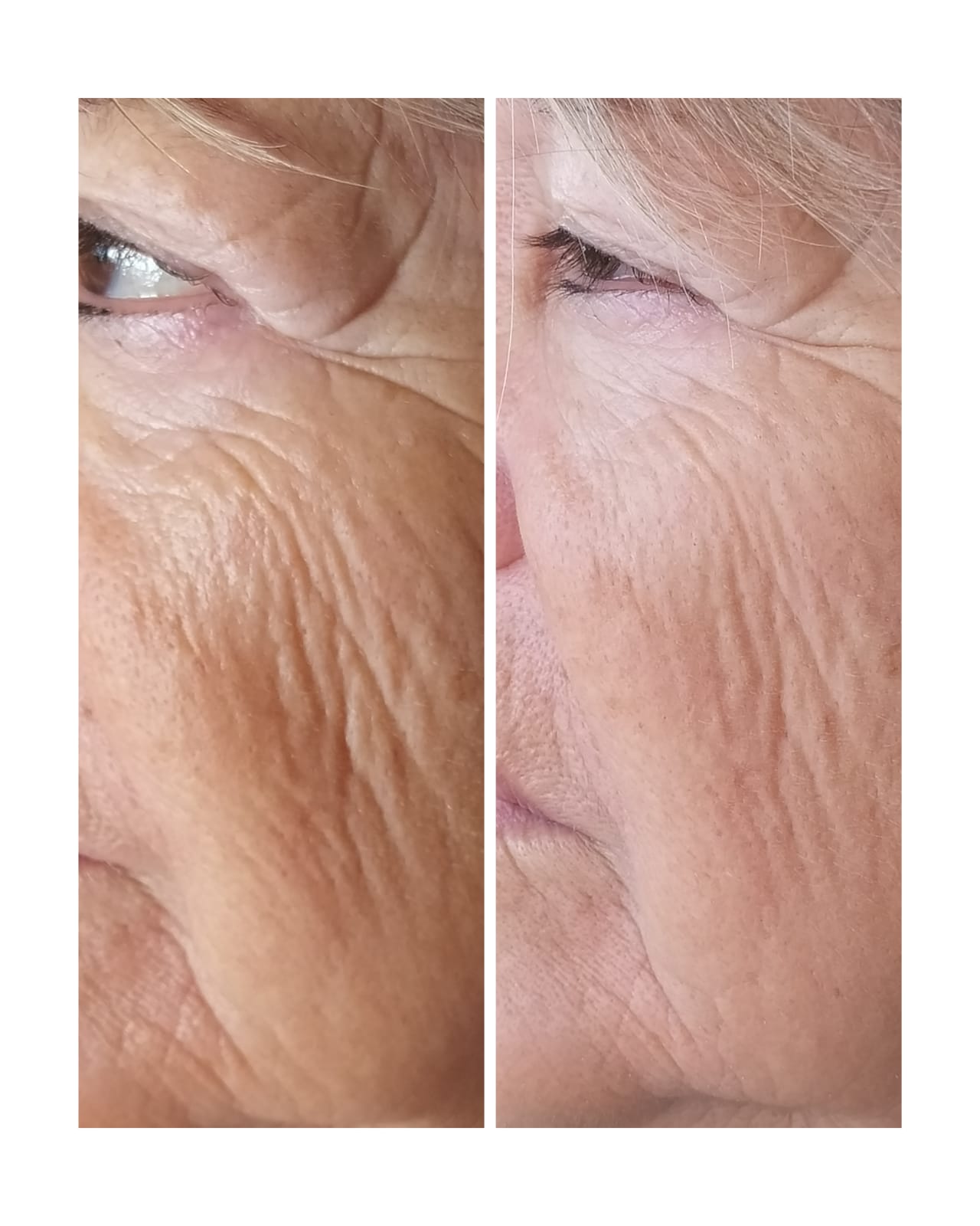 Antes y después - Tratamiento de arrugas faciales con hilos lisos
