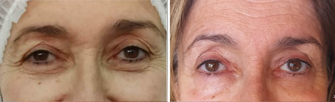 Antes y después - Contorno de ojos